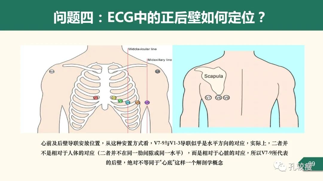 心肌梗死心电图定位的困惑及思考