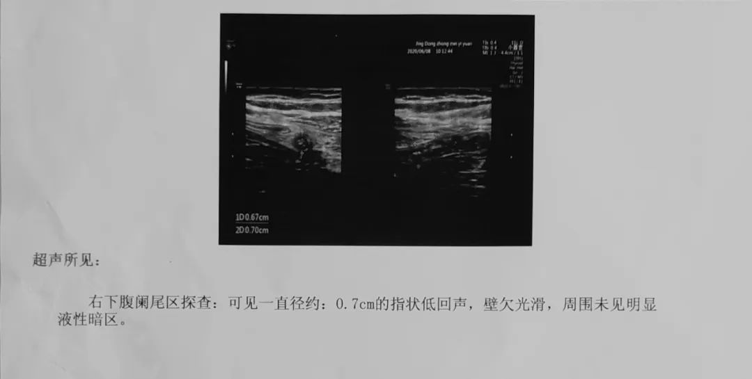 超声所见:右下腹阑尾探查,可见一直径约0.7cm的指状低回声