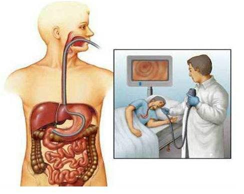 胃痛,反酸,烧心,胀气,哪个是胃癌的症状?
