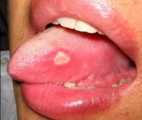 临床所见几乎100%的白塞病患者会出现反复口腔溃疡(俗称"口疮"),严重