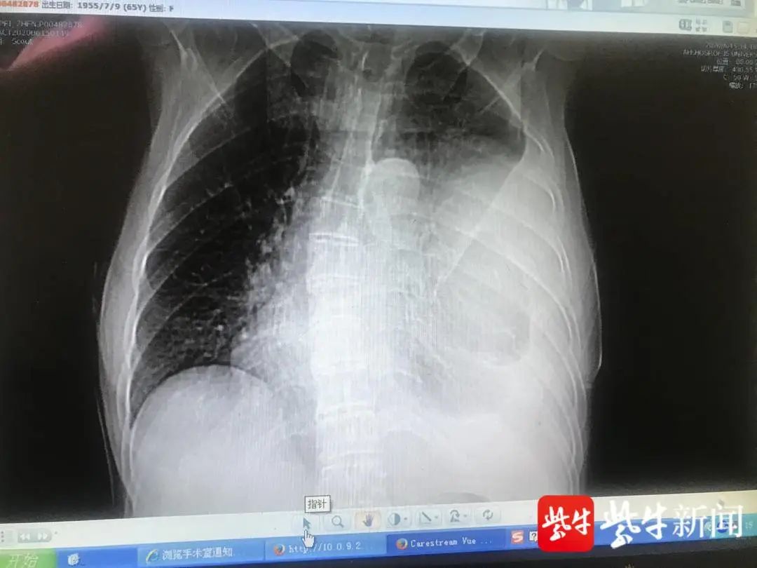 64岁女子胸腔取出5斤重肿瘤!占了整个胸腔80%