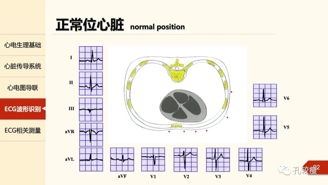 心电图诊断入门:导联基础及图形识别