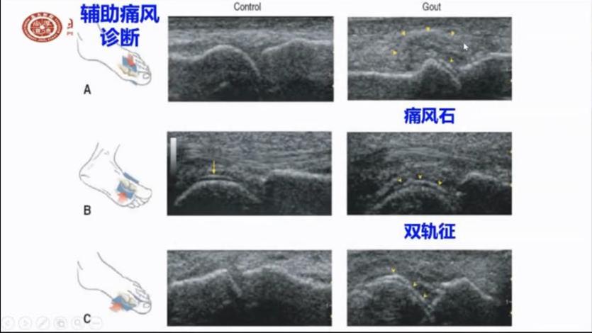 晶体相关关节炎最常见的是痛风,痛风在超声下一般表现为"痛风石","