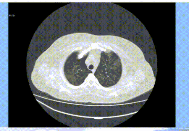 误诊3次,医生惊呼:这个肺炎不简单 | cacp 2020