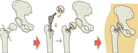 哪些股骨颈骨折的病人需要做人工关节置换?