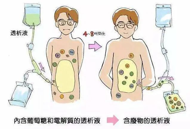 援滇澜沧县第一人民医院首例腹膜透析置管术顺利完成