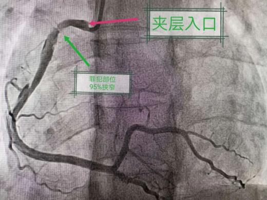 一例罕见的心血管疾病——自发性冠状动脉夹层病例报告