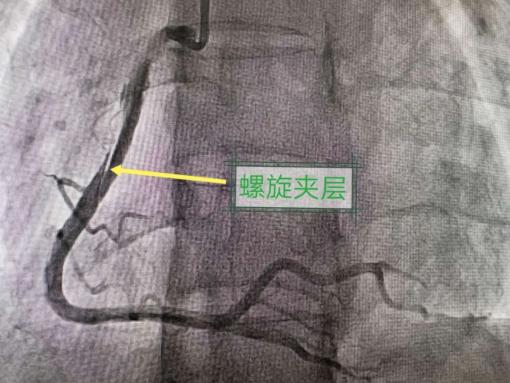 一例罕见的心血管疾病——自发性冠状动脉夹层病例报告