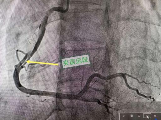 真相大白:患者右冠脉开口-近-中段自发螺旋夹层,夹层起始于右冠开