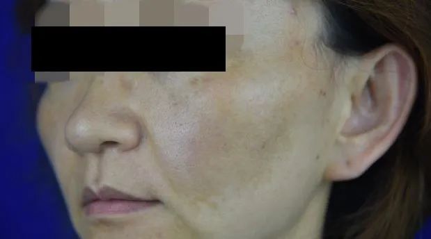 黄褐斑,中医称为"黧黑斑"肝斑"等,是一种获得性面部呈现局限性对称