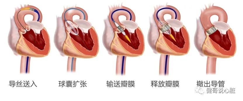 给心脏修阀门经导管主动脉瓣置换术