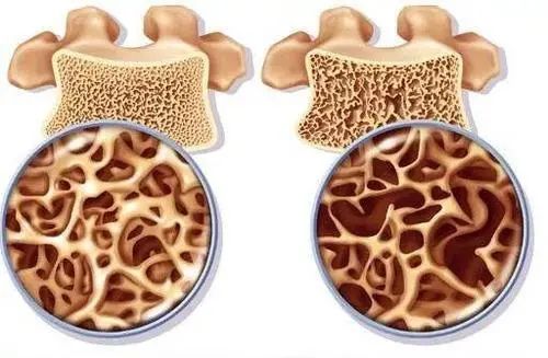明明骨密度正常,为何发生骨质疏松性骨折?