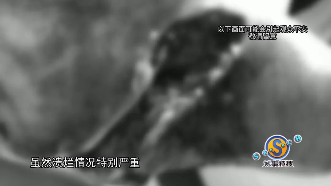 徐医生先后为患者进行了三次手术 伤口进行清创 补充足部溃烂的位置