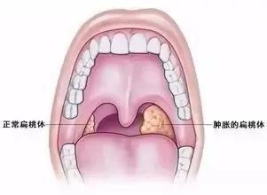 慢性咽炎究竟是怎么回事