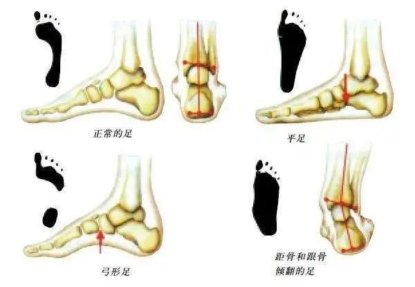 孩子的脚扁平足怎么办?这一篇解释清楚