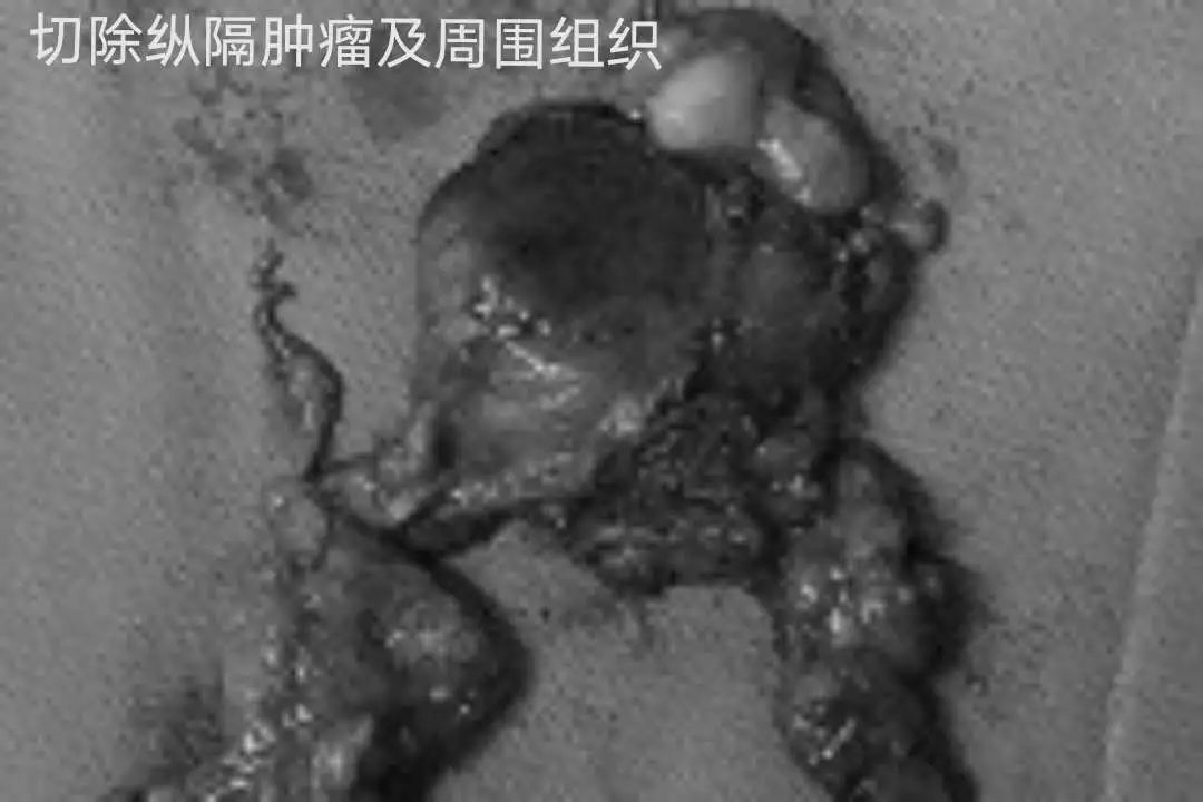 标志着我院胸外科手术治疗进入了新的阶段,胸部肿瘤手术治疗技术达到