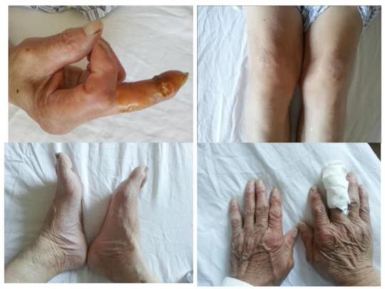 老年人超30处关节肿痛,你只会想到类风湿关节炎吗?