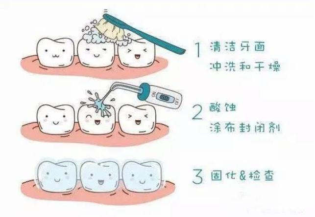 呼和浩特市口腔医院免费为6岁至8岁的儿童做窝沟封闭