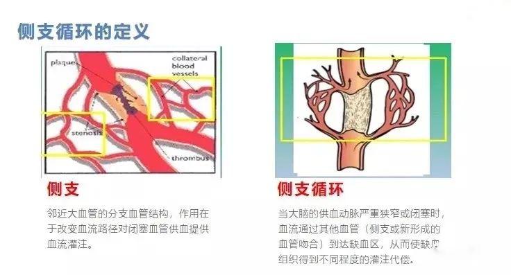 侧枝循环——颅内血管的救火队,你的是"安全状态"吗?