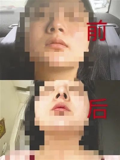 多名女子整容后鼻子歪了：不能证明是手术导致