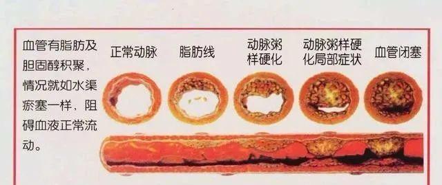 甘油三酯偏高这3种食物不要吃若你爱吃血管或加速变堵