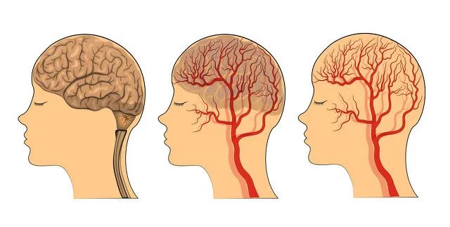 约90 的老年性头晕症是由于椎 基底动脉的供血不足所致.