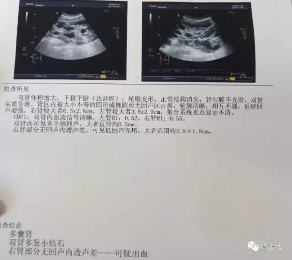 左肾囊肿 澎拜新闻