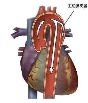 冬天,要小心这种九死一生的疾病——主动脉夹层