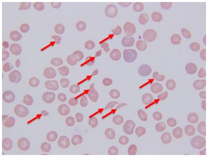 一个裂片红细胞与ttp的案例及思考