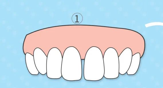 门牙牙缝太大怎么办