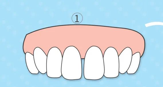 如门牙牙缝大是因为唇系带附着太低造成的,这种情况需要先进行唇系带