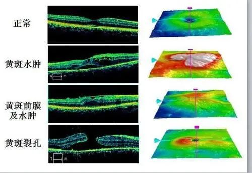 眼睛里长了"膜"?黄斑前膜到底是什么