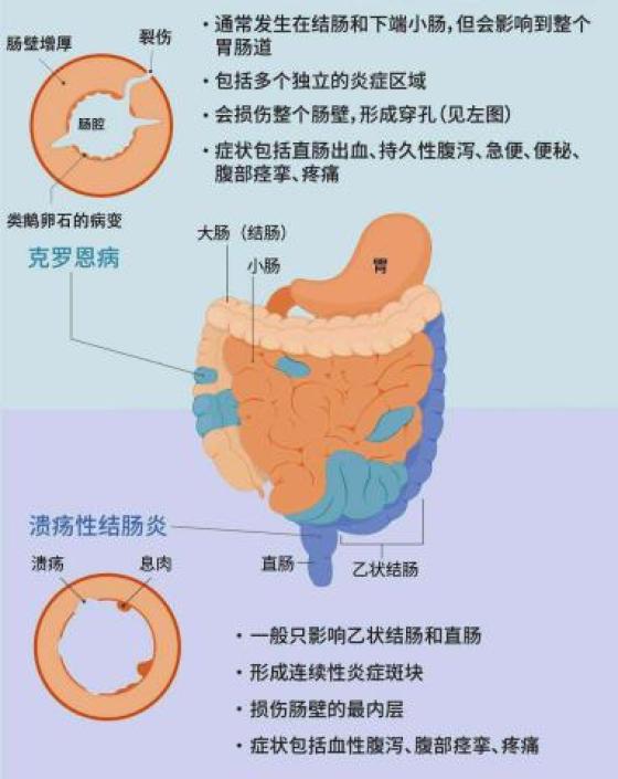 克罗恩病相关治疗药物您了解吗