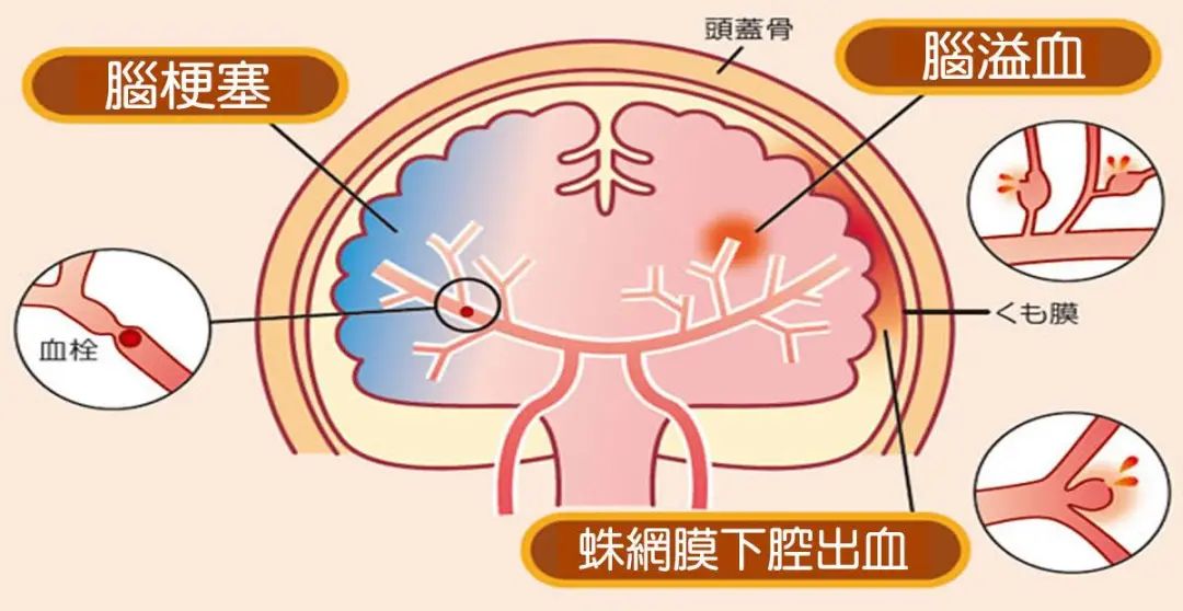 秋冬季是脑梗,心梗高发期?