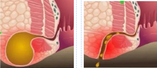 脓肿和肛瘘这对难兄难弟