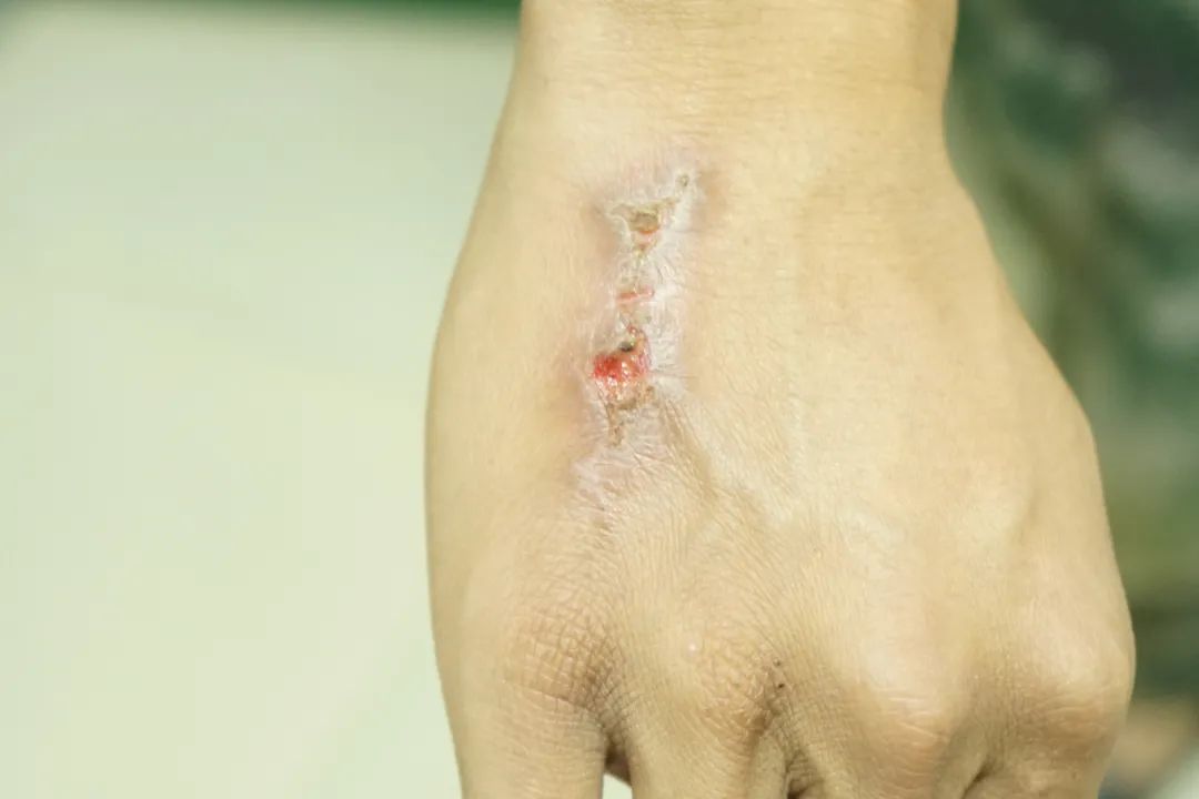 伤疤是什么意思 澎拜新闻