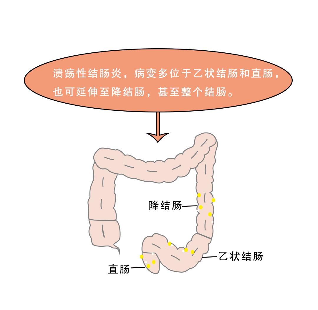 【临证一得】浅谈慢性结肠炎的中医防治