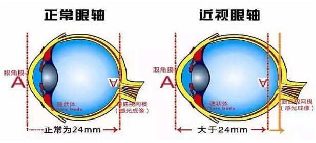 近视眼的发生原因复杂,从本质上来讲是眼球增长过度引起的,青少年