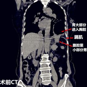 ct一看,胃都进胸腔了!