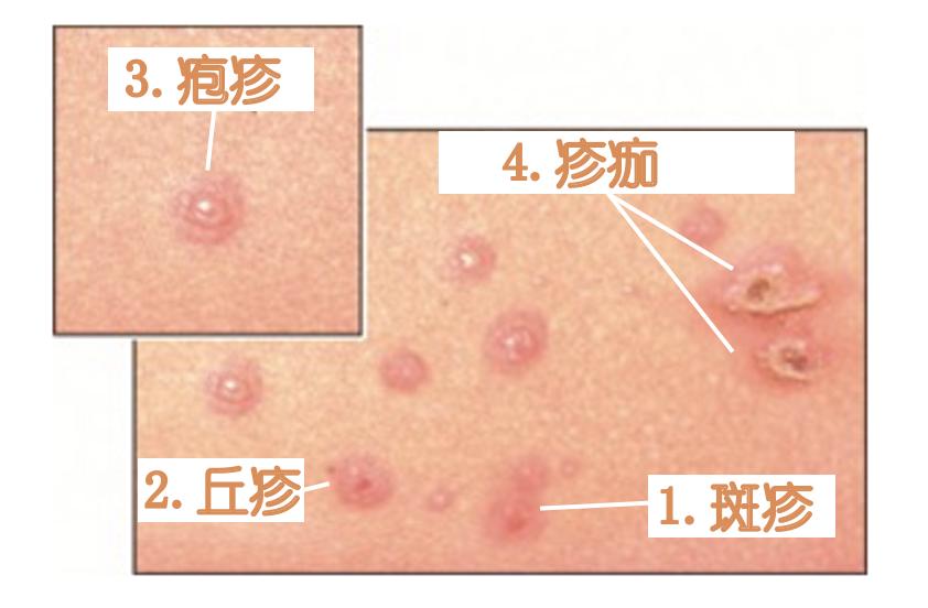 水痘皮疹长啥样? 皮疹初为红色斑疹,后依次转为丘疹,疱疹,痂疹.
