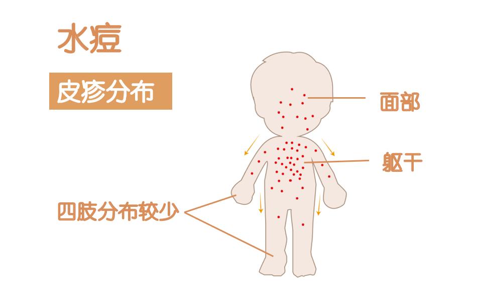 宝宝得水痘怎么办水痘有哪些并发症