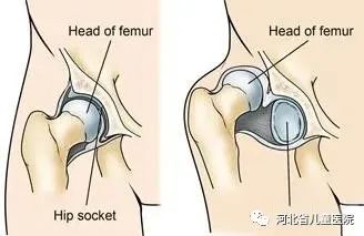 新生儿期 髋部在活动时有弹跳感,大腿或臀部的皮纹不对称,ortolani