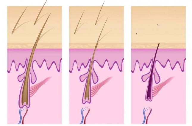什么?毛囊堵塞也会引起脱发?