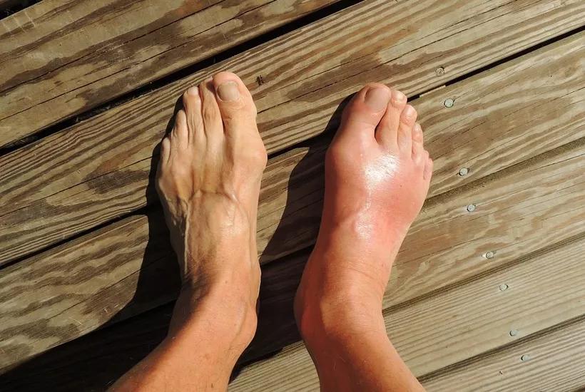 膝盖里长满雪花到底是哪里来的