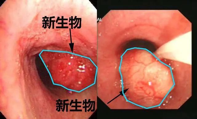 喉咙里长菜花状图片图片