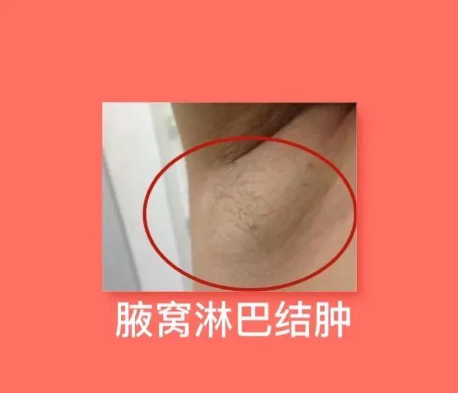 男性腋下淋巴结肿大图片