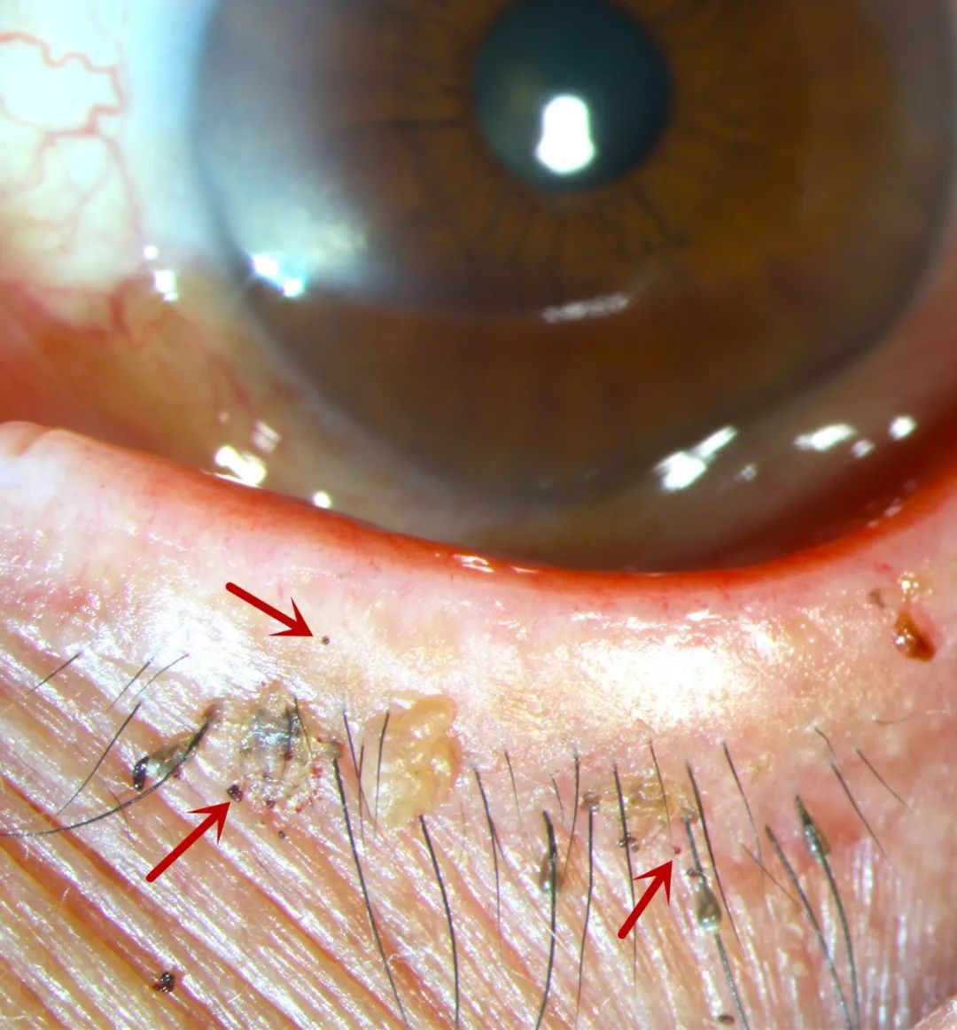 为排泄物图2:黄色箭头处为若虫图3:黄色箭头处为成虫02"阴虱"如何传播