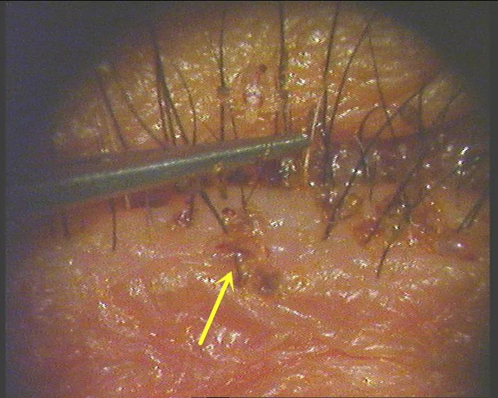 阴虱主要通过性接触,直接或间接接触传播,因为眼睑存在睫毛生长,相对