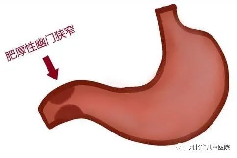 先天性肥厚性幽门狭窄是由于幽门环肌肥厚