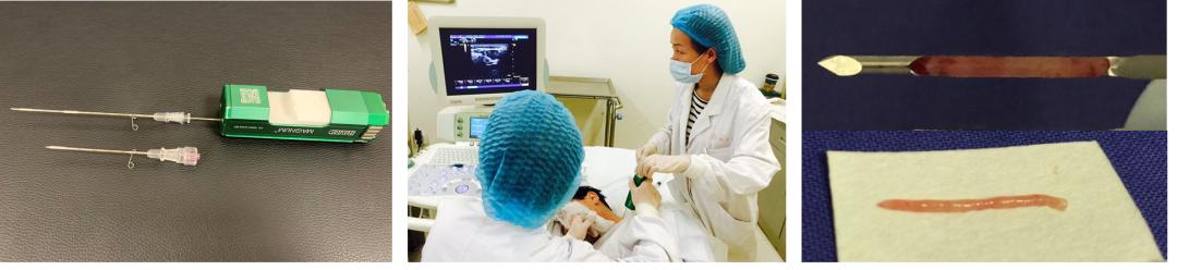 瑞金新技术十四超声引导下粗针穿刺活检在淋巴瘤诊疗中的应用